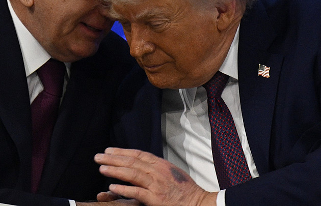 Modřina ve tvaru Grónska? Trump si přivodil novou podlitinu, prozradil jak